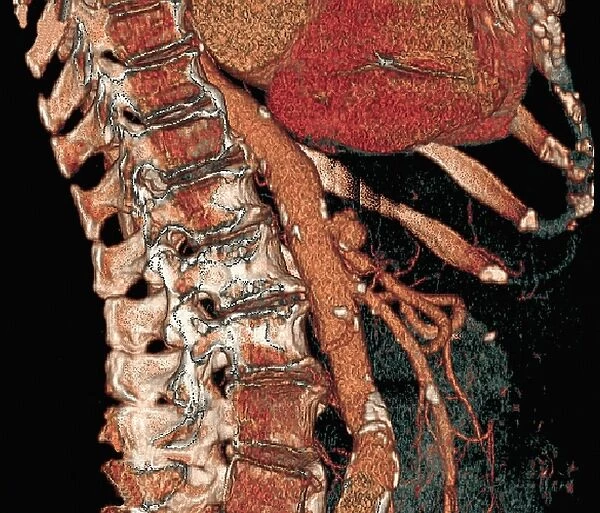 Abdominal aorta and spine, 3D CT scan
