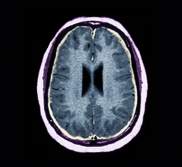 Bacterial meningitis, MRI scan