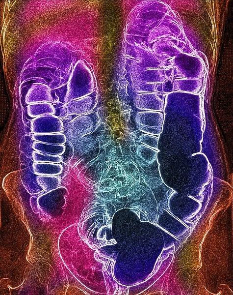 Coloured X-ray of the colon after a barium enema