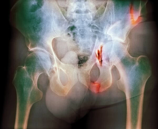 Fractured pelvis, X-ray