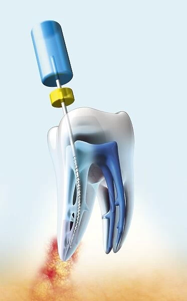 Root canal dental treatment, artwork