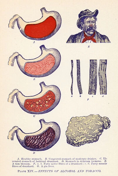 Effects of Alcohol and Tobacco (colour litho)