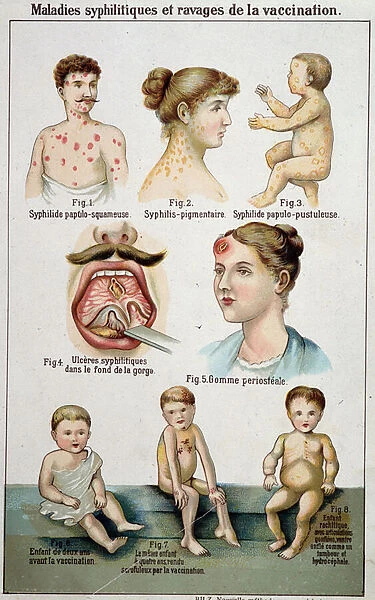 Plate illustrating the different dorms of syphilitic diseases