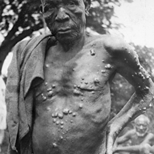 Man with leprosy, Mombasa, Kenya, East Africa