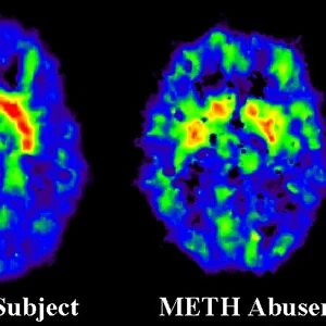 Brain damage due to drugs, PET scans C014 / 1177