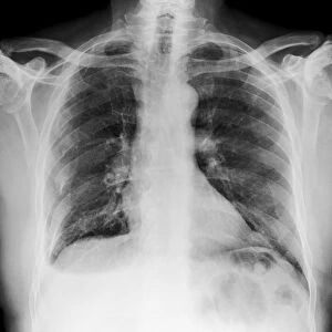 Broken ribs, X-ray C017 / 7566