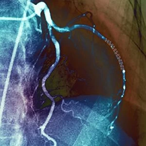 Coronary stent, X-ray F006 / 9141