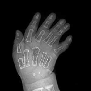 Extra fingers, X-ray C017 / 8007