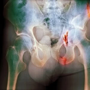 Fractured pelvis, X-ray
