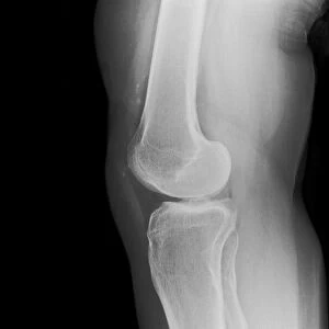 Removed kneecap, X-ray C017 / 7556