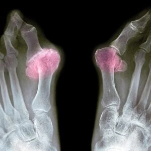 X-ray of bunions on the toes
