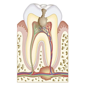 Cross section biomedical illustration of pulp and root abscess in molar