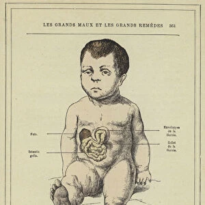 Hernie ombilicale chez un jeune enfant (colour litho)