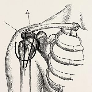 excision of the shoulder, medical equipment, surgical instrument, history of medicine