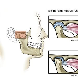 Temporomandibular joint, normal and dislocated